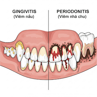 bệnh nha chu ở chó